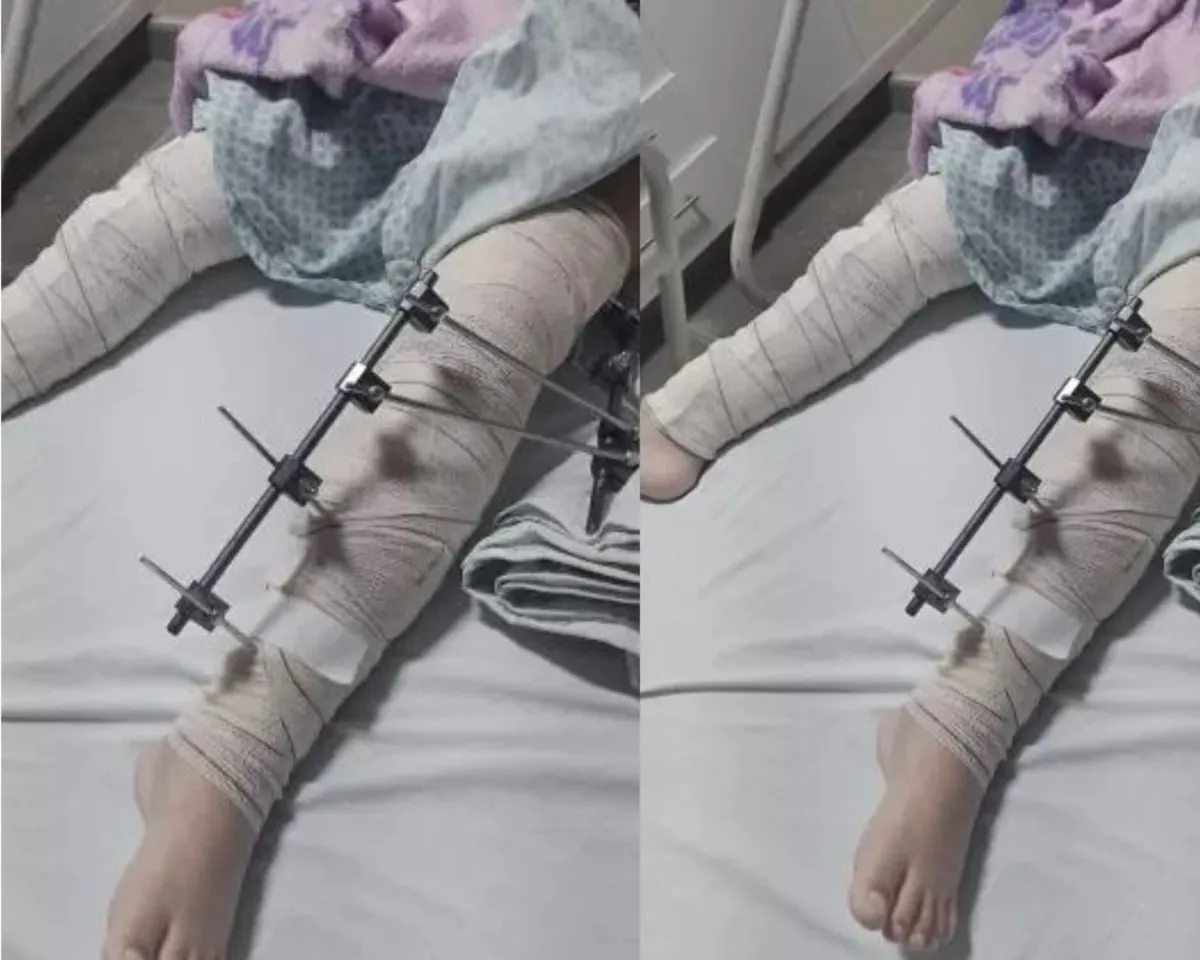 SUS: médicos operam perna errada de menina de 6 anos e caso gera revolta 2
